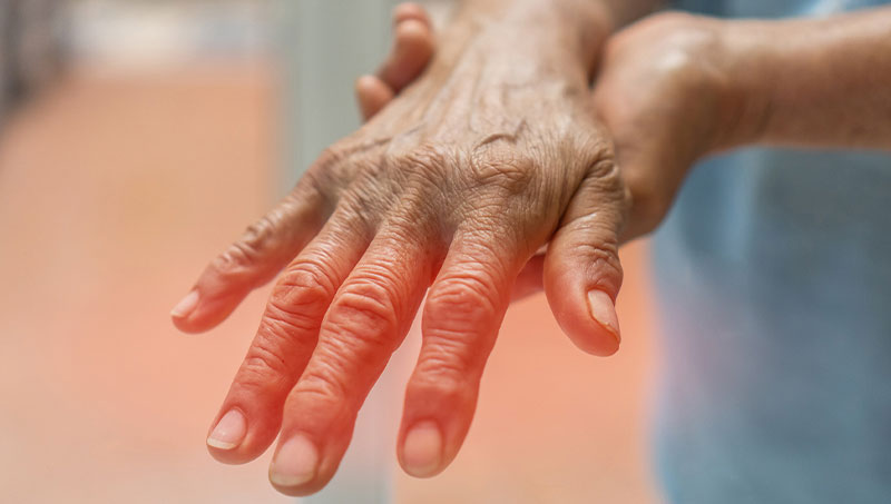 کارگاه تجویز تمرین برای بیماران مبتلا به آرتریت